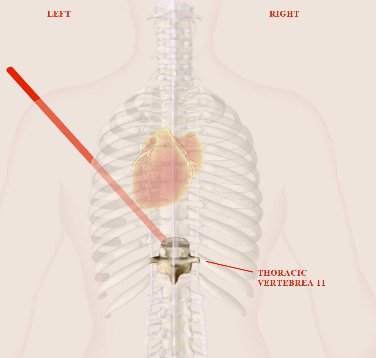 Graphic of 11th Thoracic Vertebrea